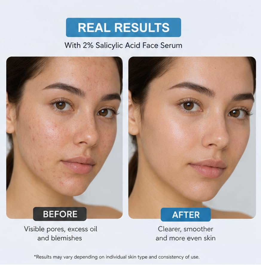 Aralekha 2 Percent Salicylic Acid Face Serum for Oily and Blemish Prone Skin Helps Refine Skin Texture Supports Clear Looking Skin Lightweight Formula 30 ml